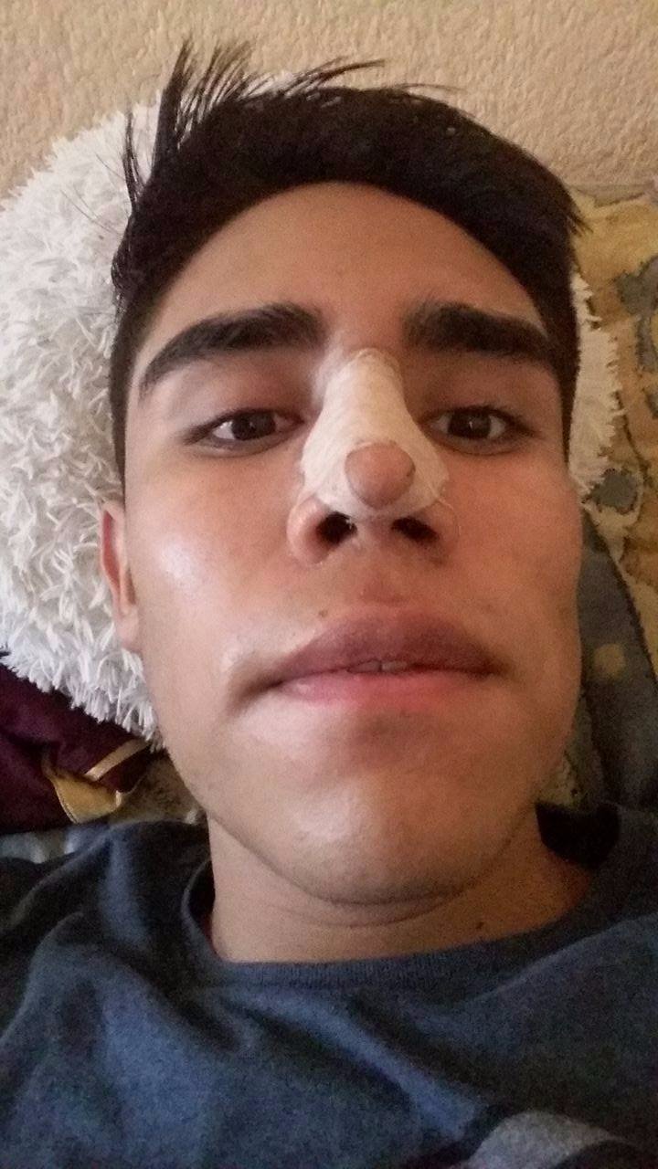 para que sirve el vendaje rinoplastia